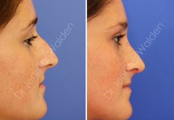 Septorhinoplasty before 1112641