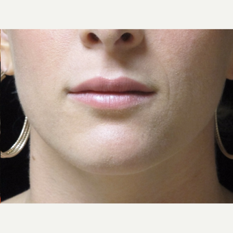 25-34 year old woman treated with Lip Augmentation after 3503004