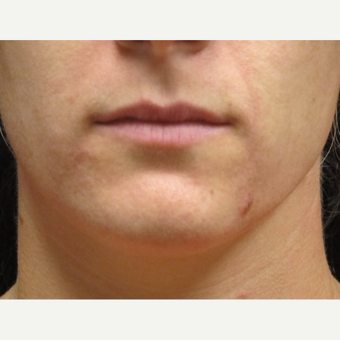 25-34 year old woman treated with Lip Augmentation before 3503004