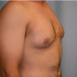 25-34 year old man treated with Breast Reduction before 3722138
