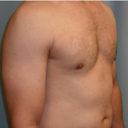 25-34 year old man treated with Breast Reduction after 3722138