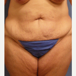 45-54 year old woman treated with Tummy Tuck before 3537302