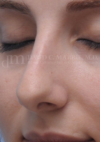 Rhinoplasty 361321