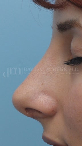 Rhinoplasty after 361321