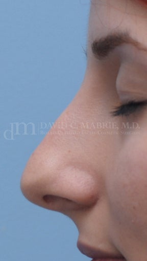 Rhinoplasty before 361321
