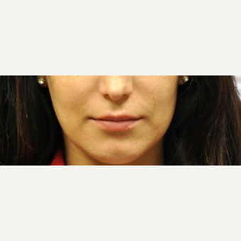 18-24 year old woman treated with Lip Augmentation before 3175911