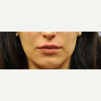 18-24 year old woman treated with Lip Augmentation after 3175911