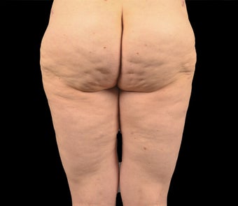 35-44 year old woman treated with Liposuction after 2165188
