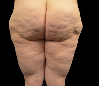 35-44 year old woman treated with Liposuction before 2165188