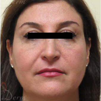 45-54 year old woman treated with Restylane for bags/dark circles under the eyes after 3416372