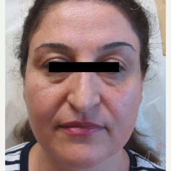 45-54 year old woman treated with Restylane for bags/dark circles under the eyes before 3416372