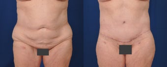 55-64 year old woman treated with Body Lift after 3487538
