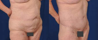 55-64 year old woman treated with Body Lift 3487538