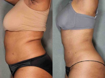 48 Year Old Female Treated for Unwanted Fat after 1046531