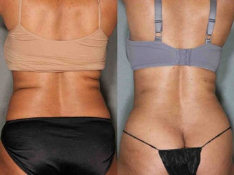 48 Year Old Female Treated for Unwanted Fat before 1046531