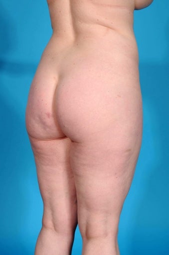 Brazilian Butt Lift before 1399977