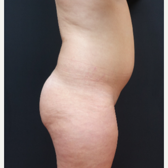 18-24 year old woman treated with Butt Augmentation before 3315498