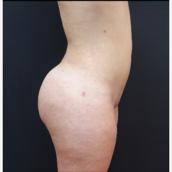 18-24 year old woman treated with Butt Augmentation after 3315498