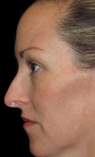 42 year old woman treated with Halo Laser 3092485