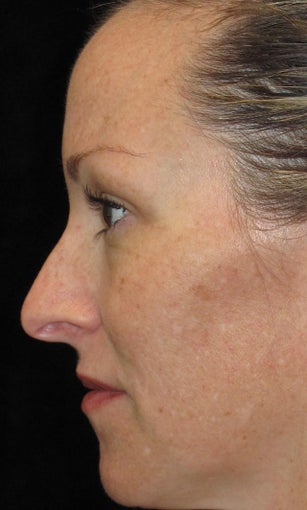 42 year old woman treated with Halo Laser 3092485