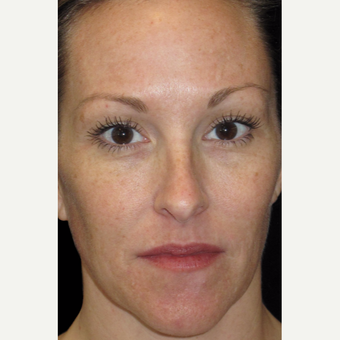 42 year old woman treated with Halo Laser before 3092485