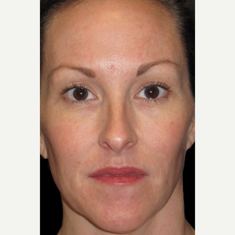 42 year old woman treated with Halo Laser after 3092485