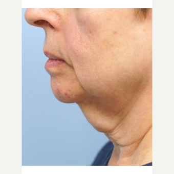 65-74 year old woman treated with Neck Lift before 3653477