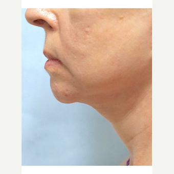 65-74 year old woman treated with Neck Lift after 3653477