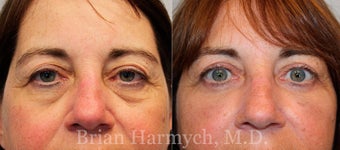62 year-old female before and 6 months after upper and lower Eyelid Surgery and Fat Transfer before 3446196