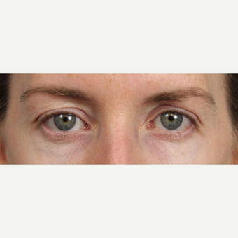 Eyelid Surgery before 3123706