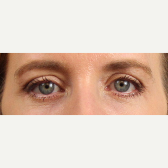 Eyelid Surgery after 3123706