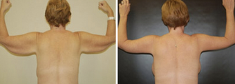 Arm Lift before 1149416