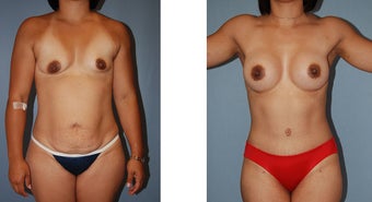 Mommy Makeover before 1152907