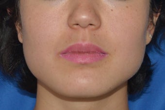 Buccal Fat Removal with Dysport (Botox) Jaw Slimming before 1008115