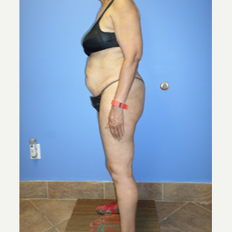 75 and up year old woman treated with Weight Loss before 3370176