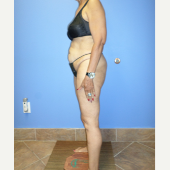 75 and up year old woman treated with Weight Loss after 3370176