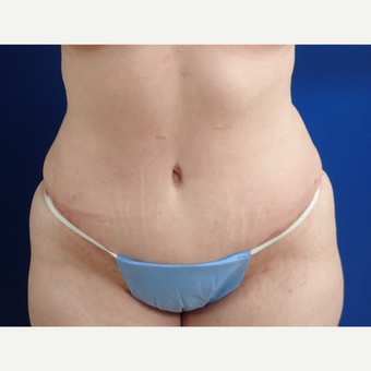 35-44 year old woman treated with Tummy Tuck after 3322491