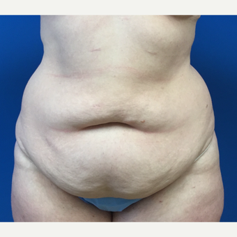 35-44 year old woman treated with Tummy Tuck before 3322491