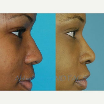 18-24 year old woman treated with African American Rhinoplasty 1703792