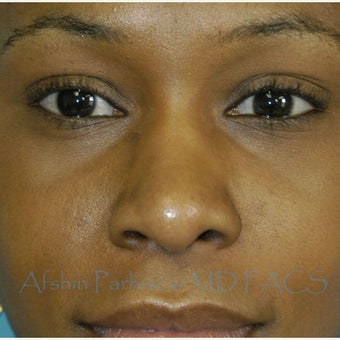 18-24 year old woman treated with African American Rhinoplasty after 1703792