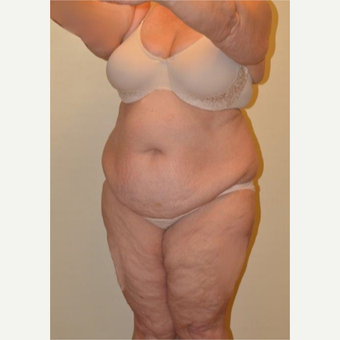 45-54 year old woman treated with Liposuction before 3658232