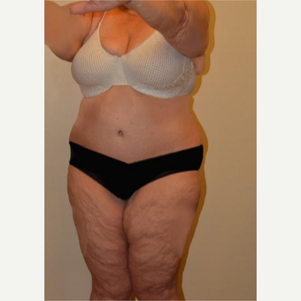 45-54 year old woman treated with Liposuction after 3658232