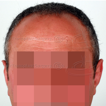 3090 FUE in two day - Result after 1 year and 2 weeks post-op before 3128156