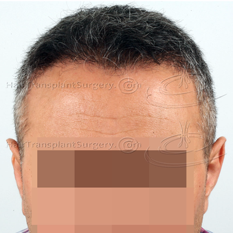 3090 FUE in two day - Result after 1 year and 2 weeks post-op after 3128156