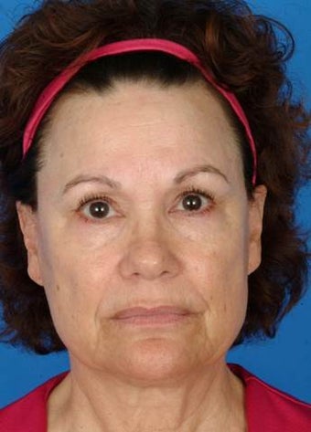 60 year old female treated with Ultherapy for neck, jawline, brows and lines around her mouth. before 1173992