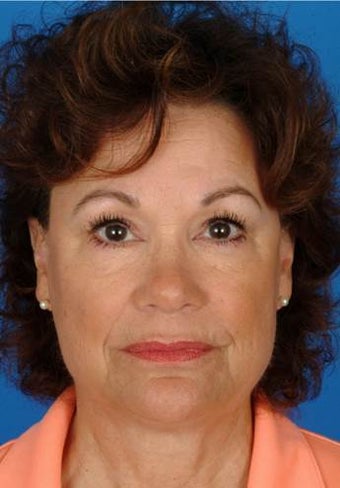 60 year old female treated with Ultherapy for neck, jawline, brows and lines around her mouth. after 1173992