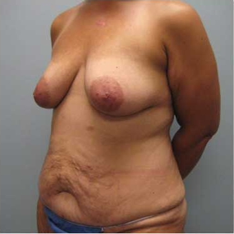 37 year old woman treated with Body Lift before 3680212