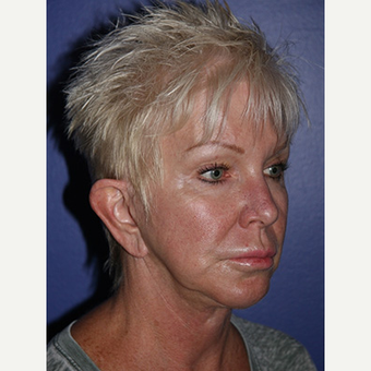 59 year old woman treated with Facelift before 3710772