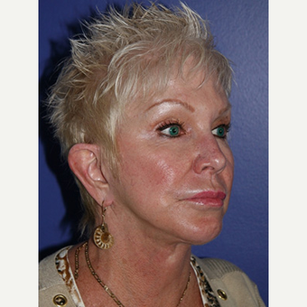 59 year old woman treated with Facelift after 3710772