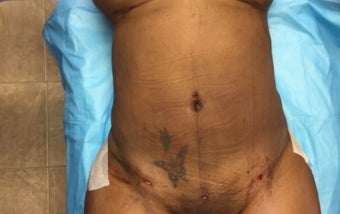 35-44 year old woman treated with Smart Lipo after 3286899